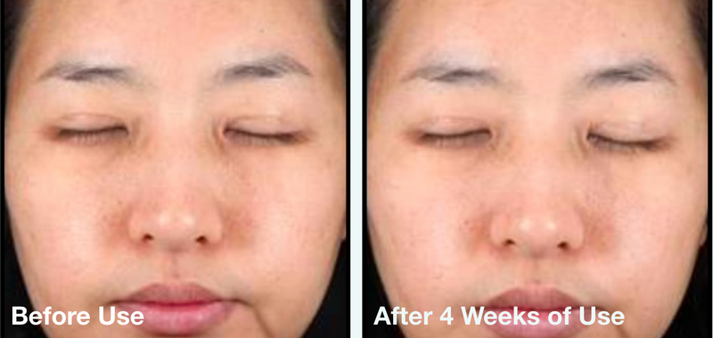 Clinical before-and-after images showing reduced melanin appearance and a more even skin tone after four weeks of Roller Gold use